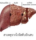 ไวรัสตับอักเสบบี